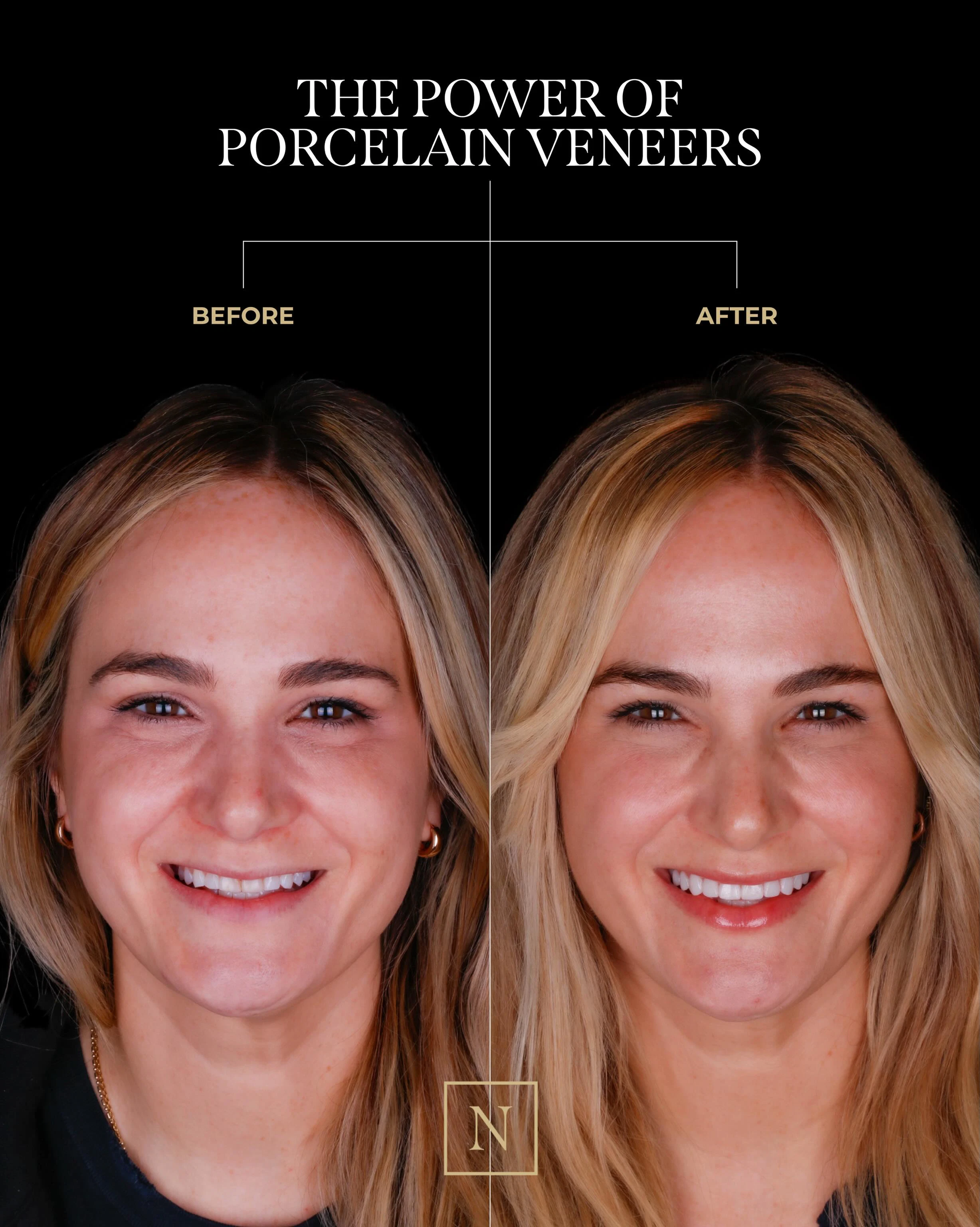 our patient before and after veneers