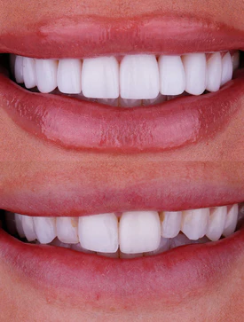 Kaitlin Duncan smile before and after