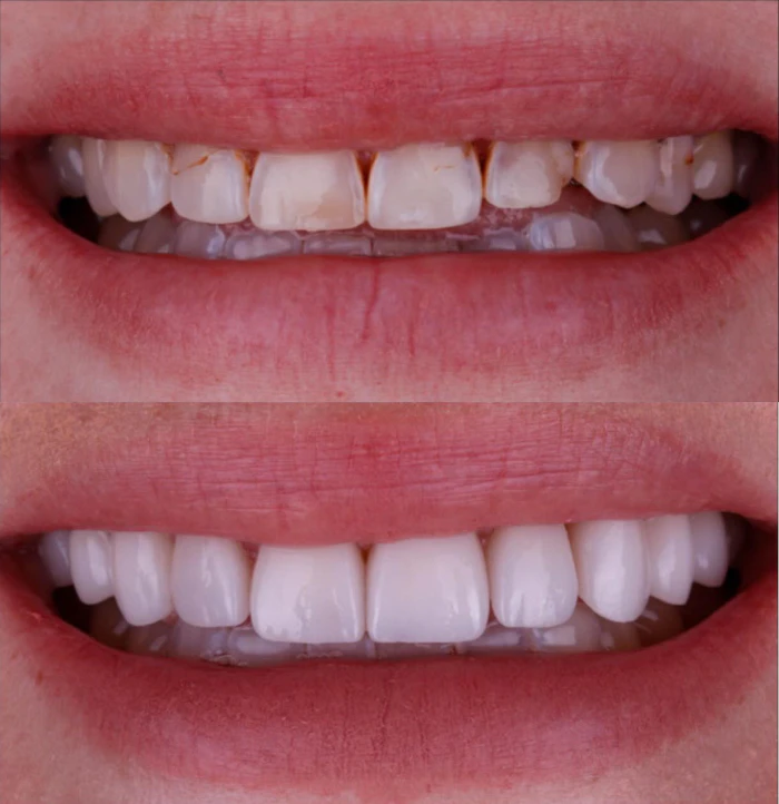 smile before and after treatment