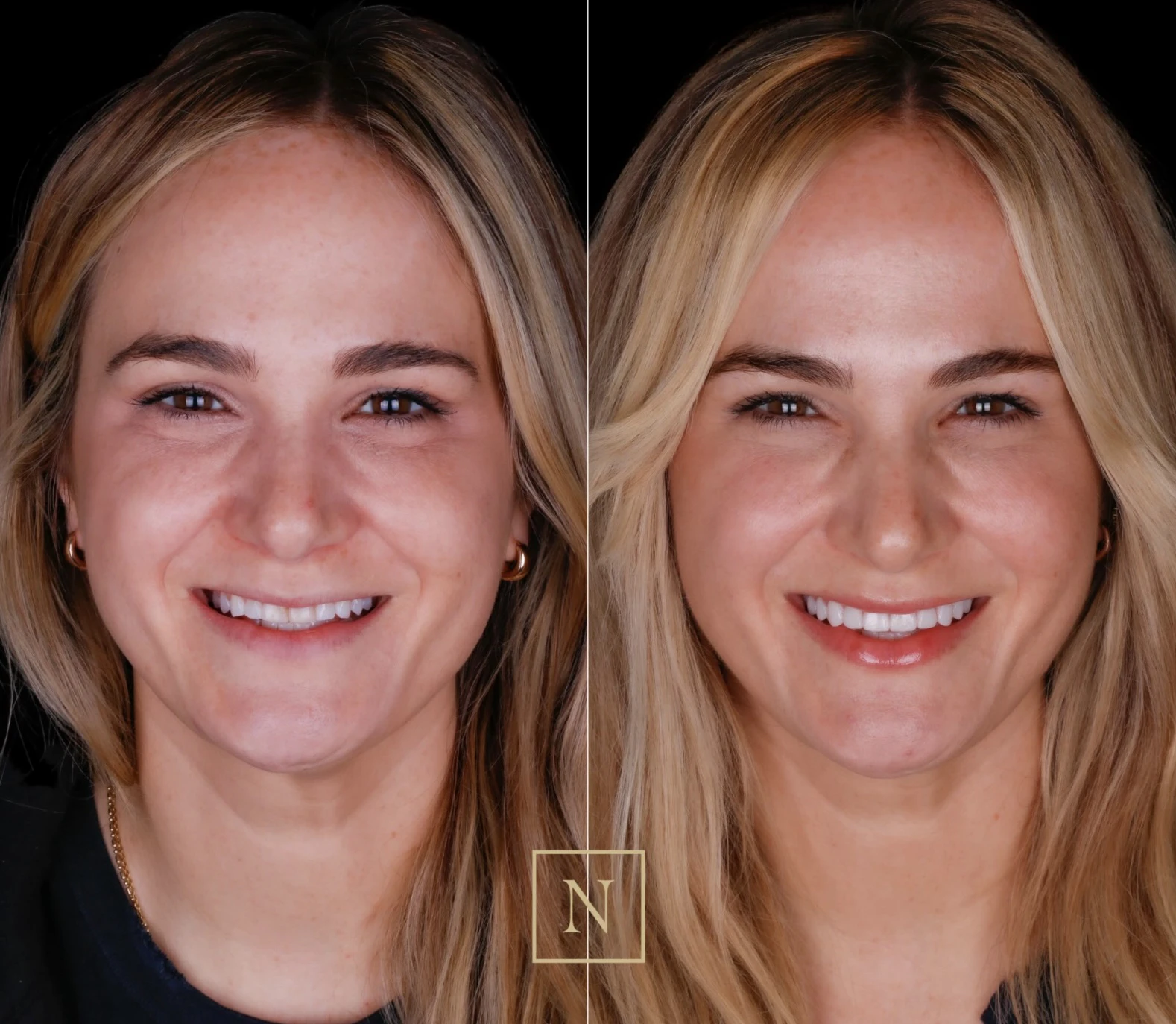 Nashville woman before and after smile makeover