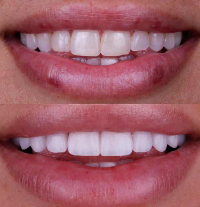 Before and after lip enhancement
