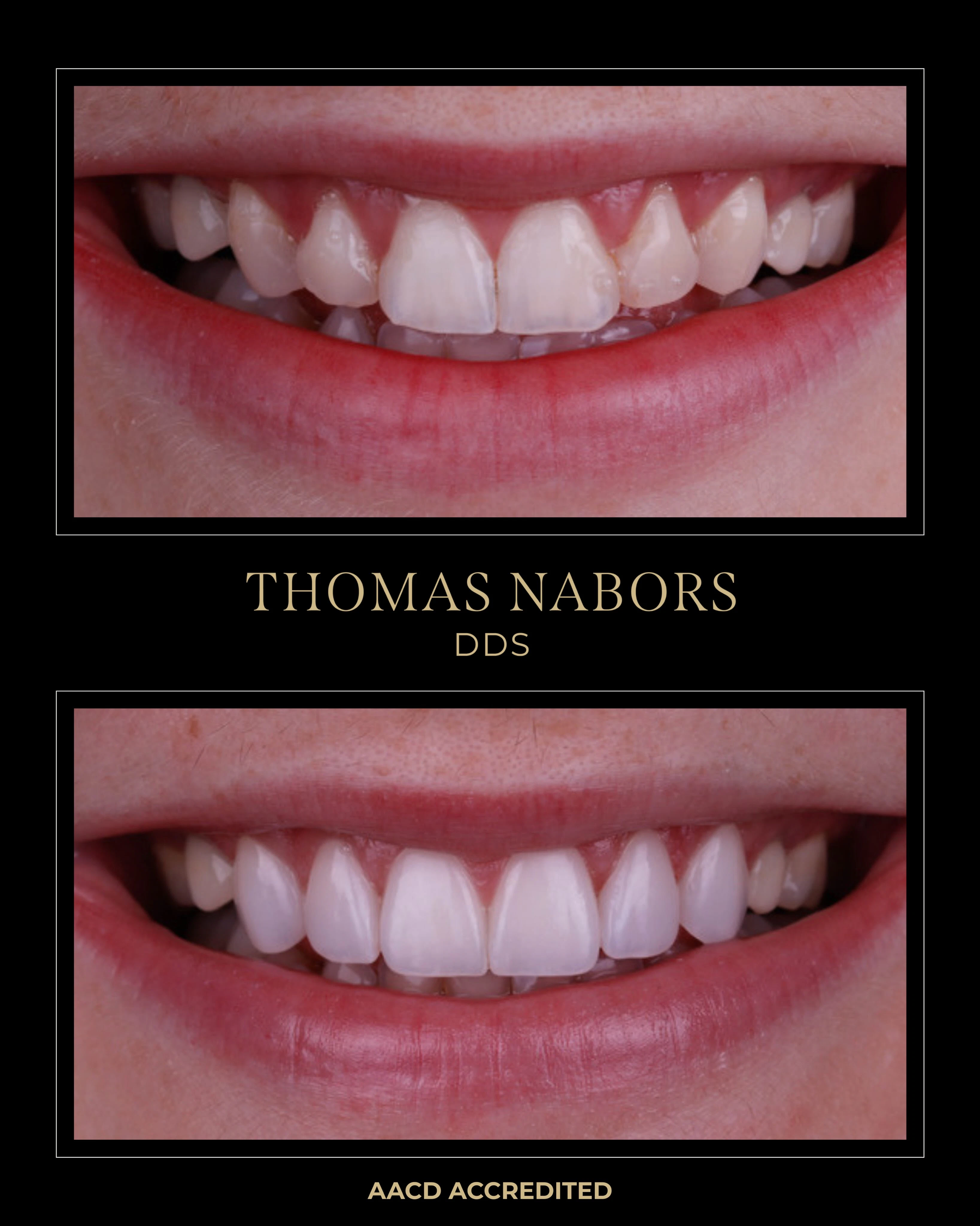 before and after veneers