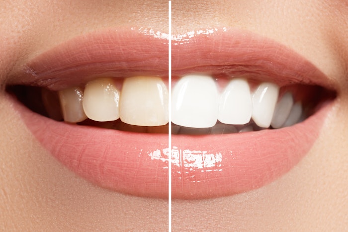 BNA teeth whitening