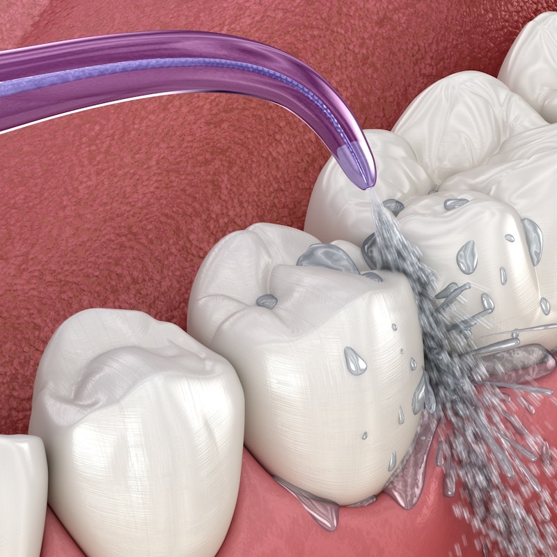 professional dental cleaning