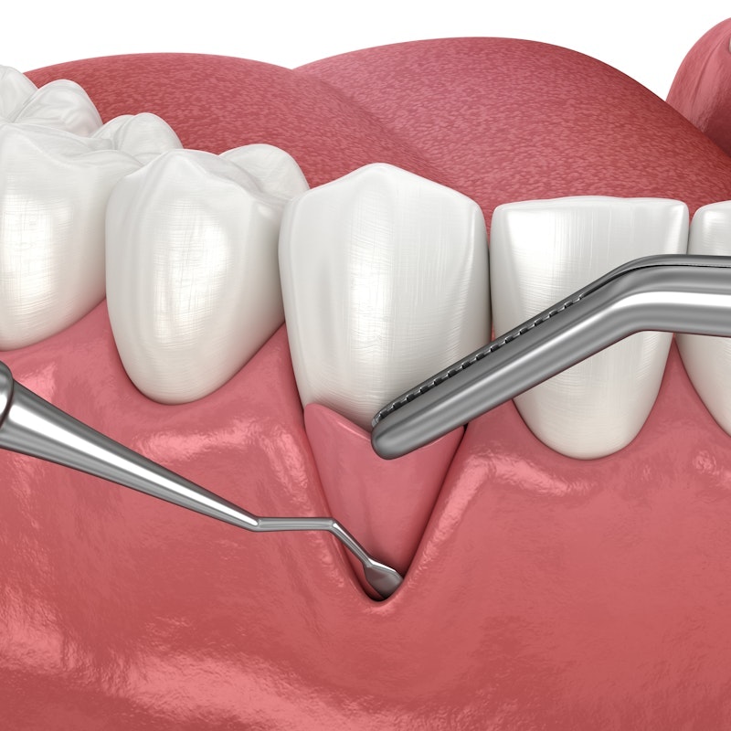 gum grafting illustration
