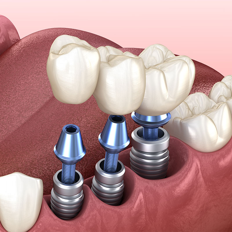 Dental implant