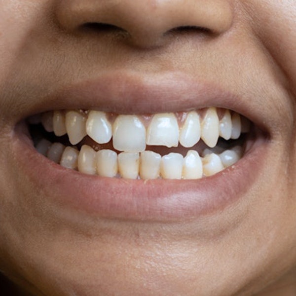 misaligned teeth