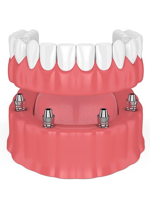 All-on-4 denture