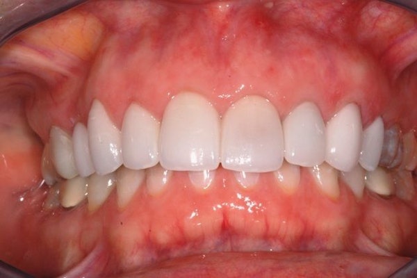 smile after cosmetic dentistry
