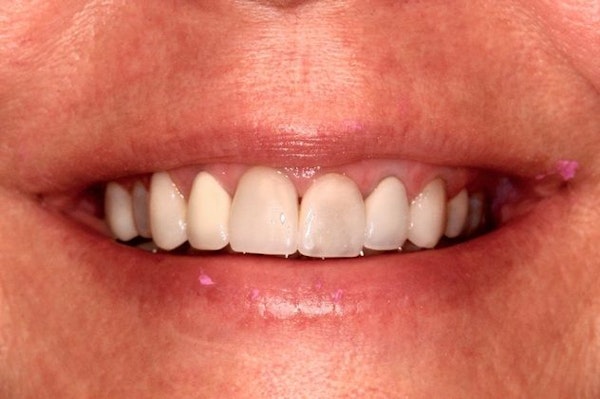 smile before cosmetic dentistry