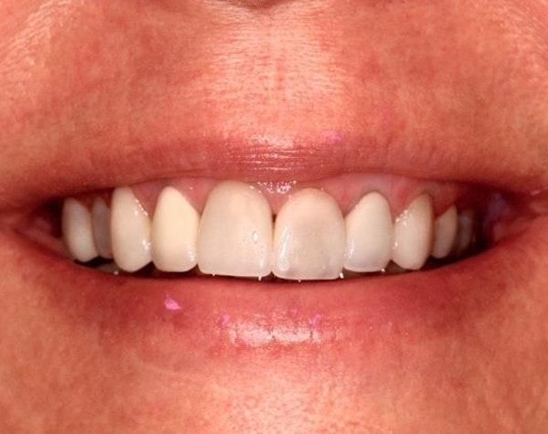 smile before cosmetic dentistry