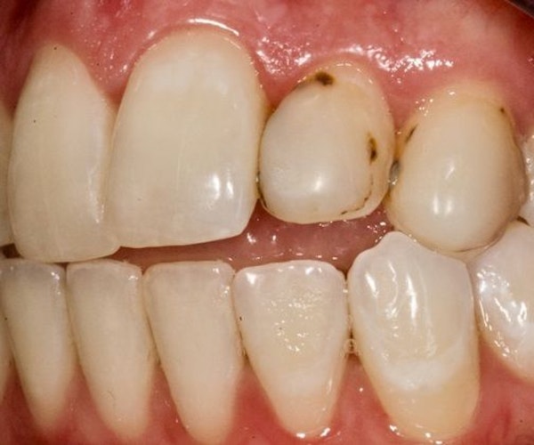 before cosmetic dentistry