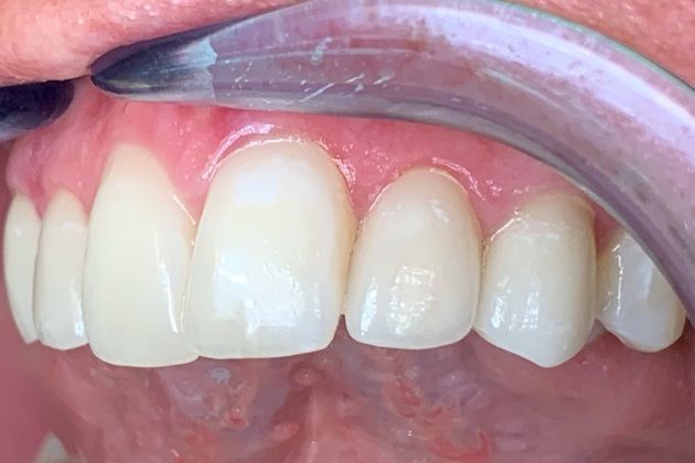 After Cosmetic Dentistry