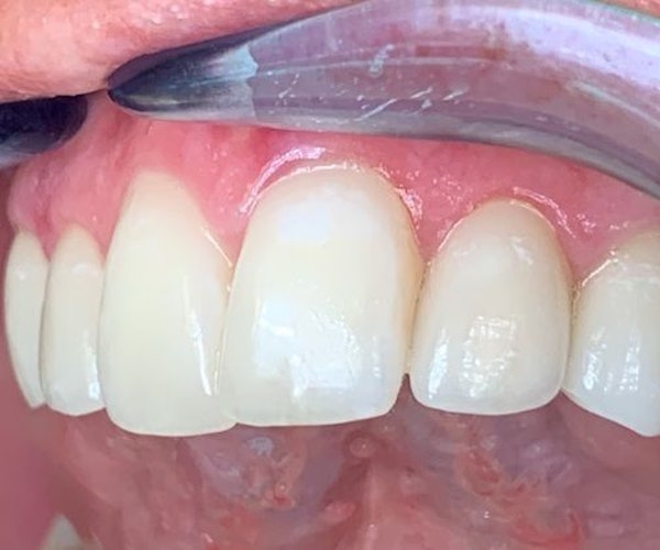 After Cosmetic Dentistry