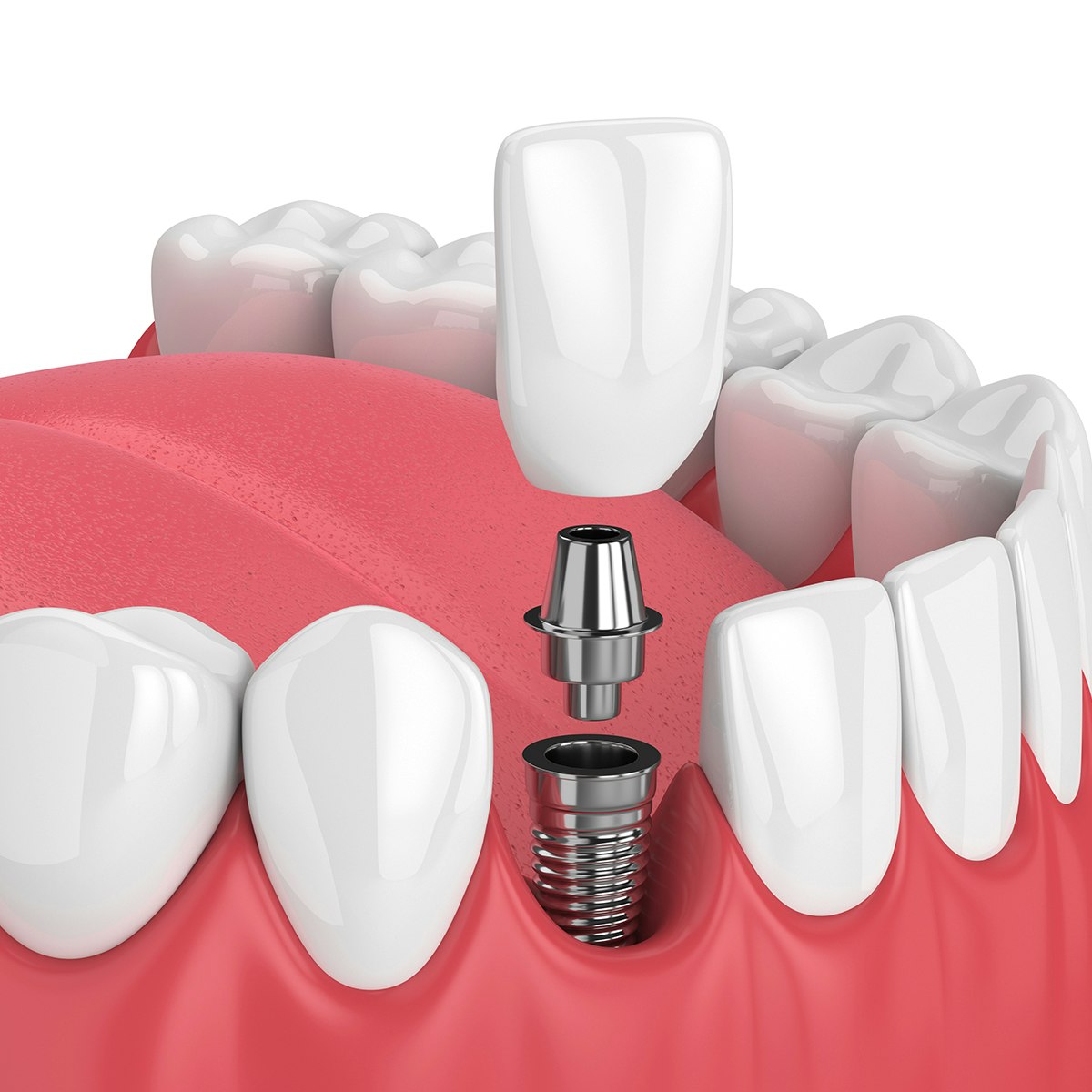 implant dentures
