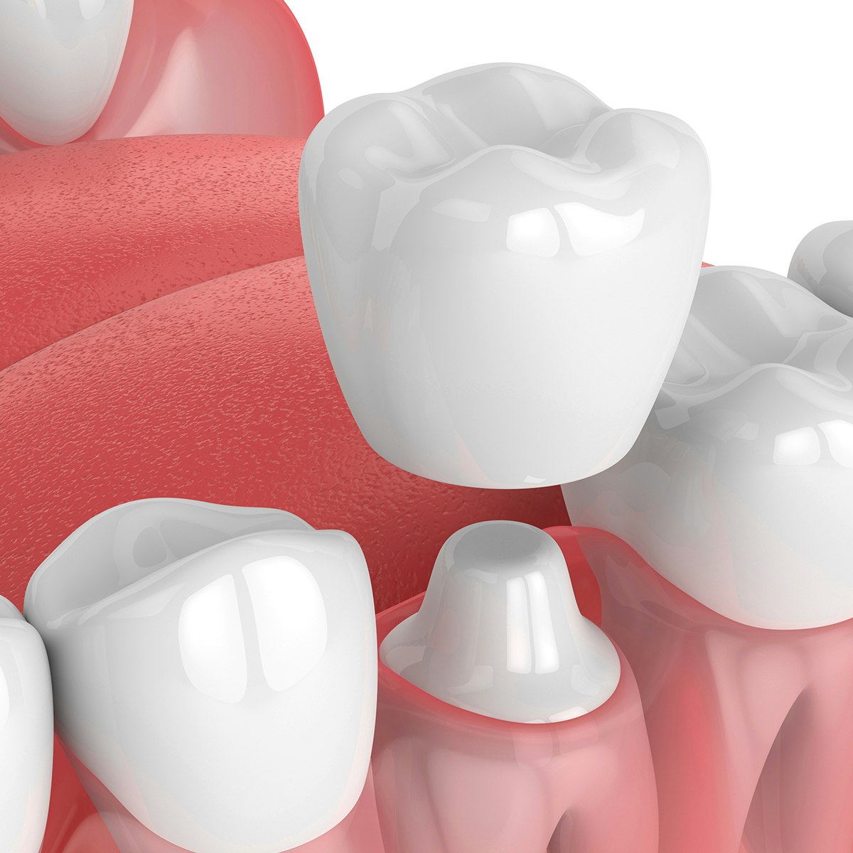 Dental Crowns