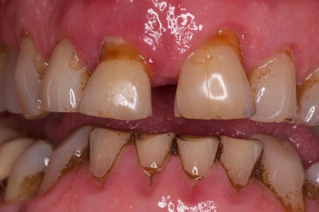 Before Dental Bridge