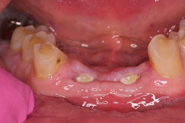 Before an implant-supported bridge