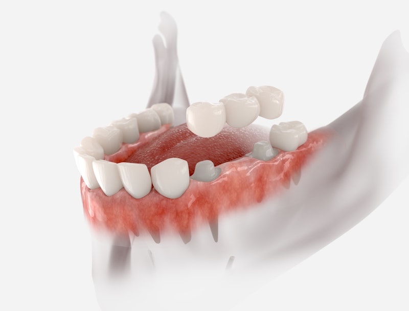 Traditional dental bridge illustration