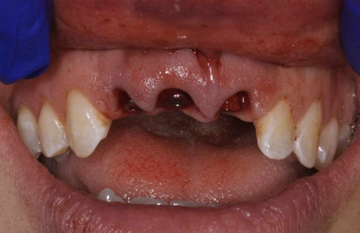 Patient missing three front teeth