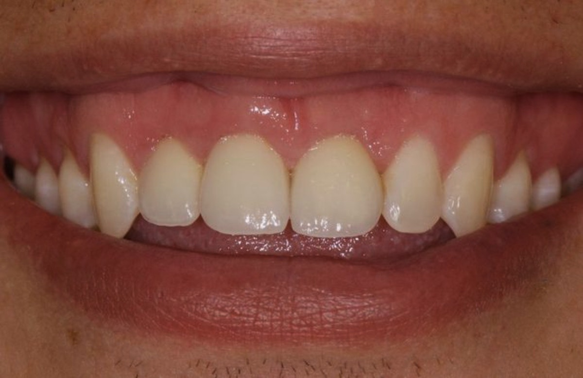 Patient with three implant-supported restorations