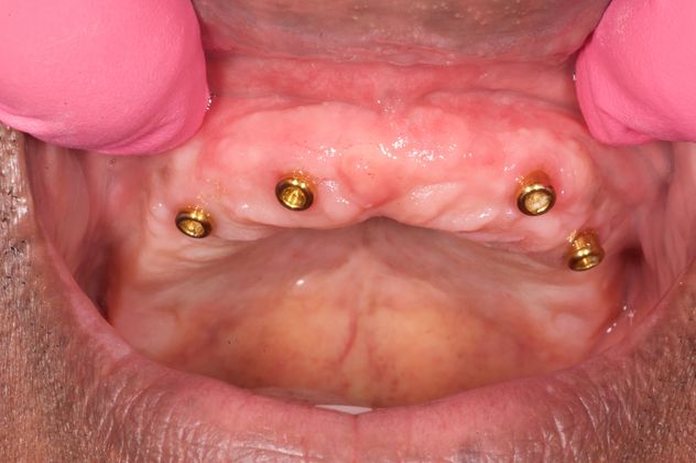Patient before All-on-4 implants
