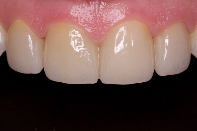 After dental crowns