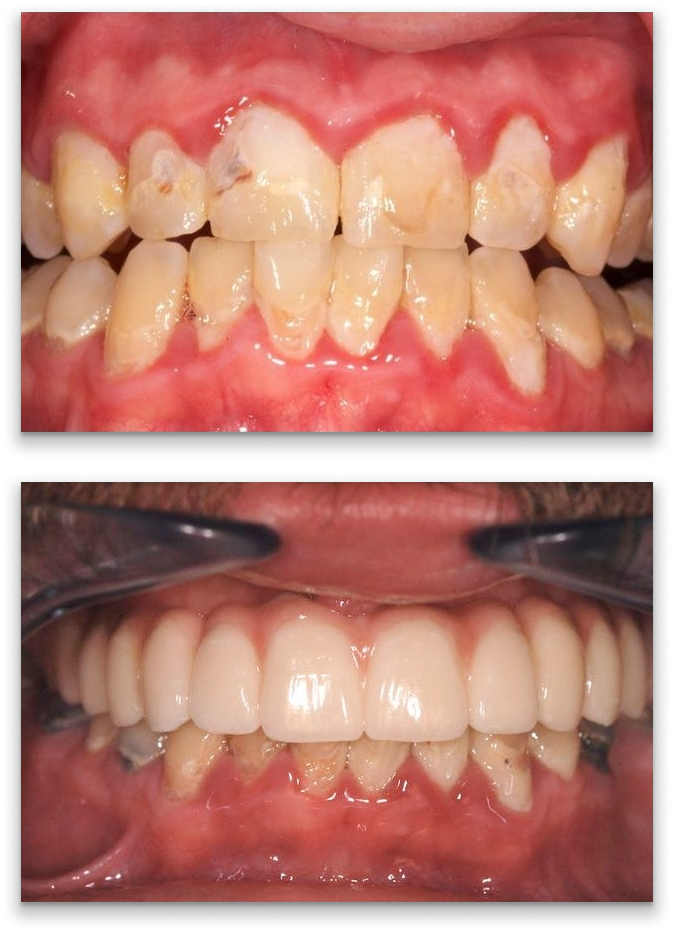 before and after restorative dentistry