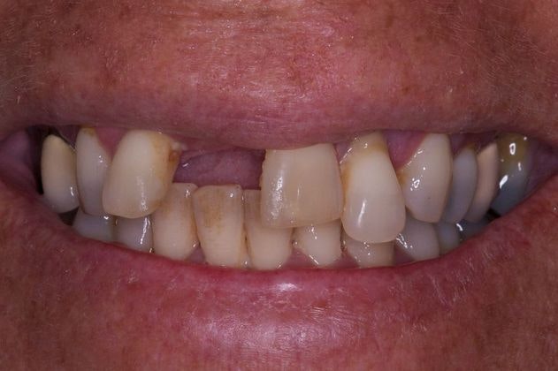 Close-up of a 38th Street Dental patient with a missing tooth and damaged teeth