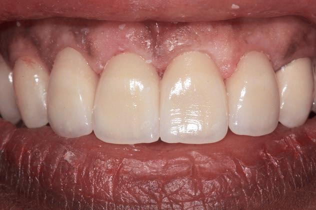 After Smile Makeover