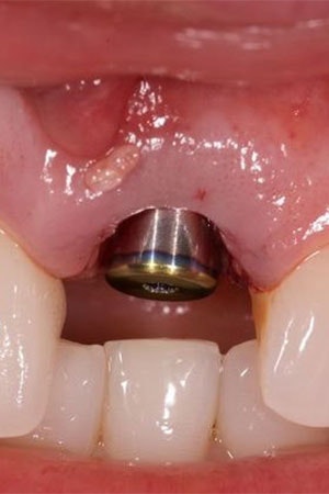 Implant placed without a restoration
