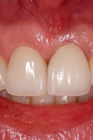 Implant placed with a restoration