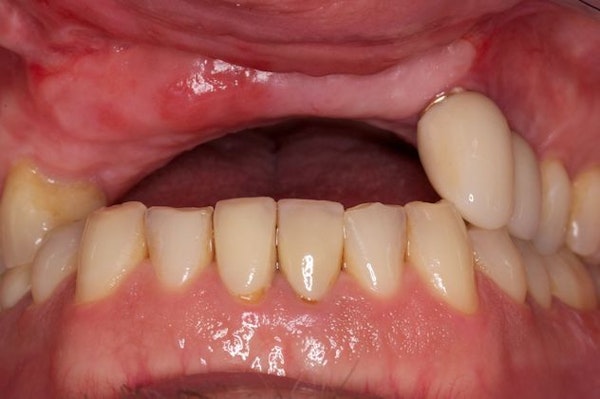 Before arch replacement