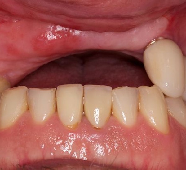 Before arch replacement