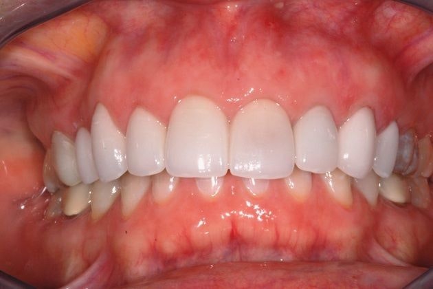 Smile after four veneers