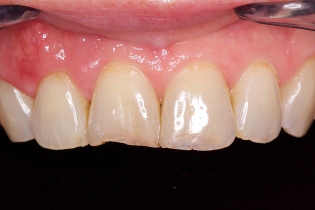 closeup of patient's worn front teeth