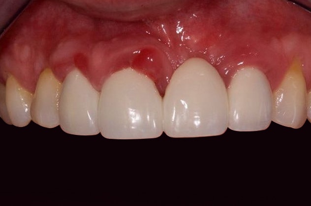 patient with fractured bridge