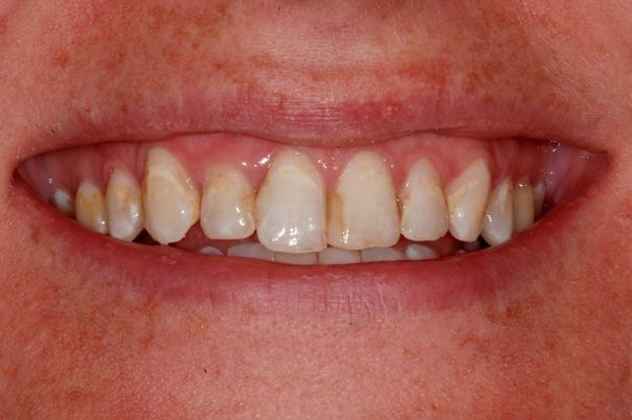 Austin patient before crowns and veneers