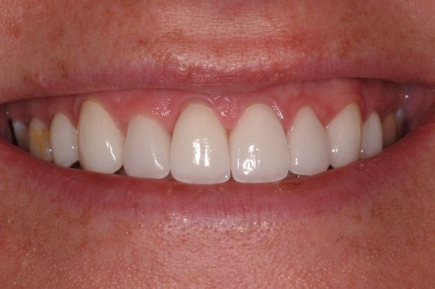 Austin patient after crowns and veneers