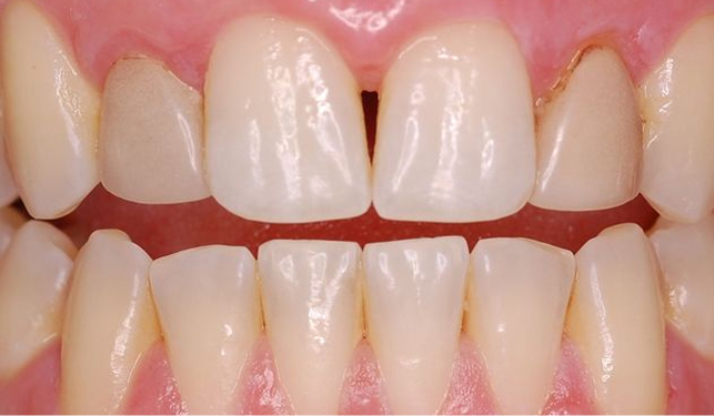 Austin patient before veneers