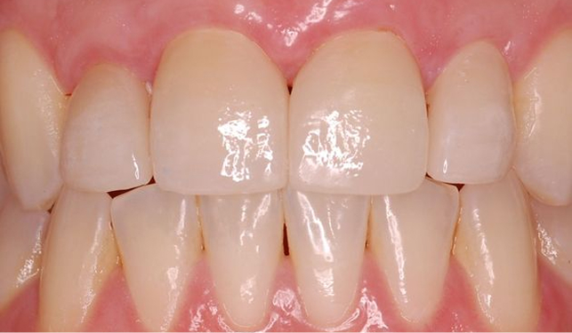 Austin patient after veneers