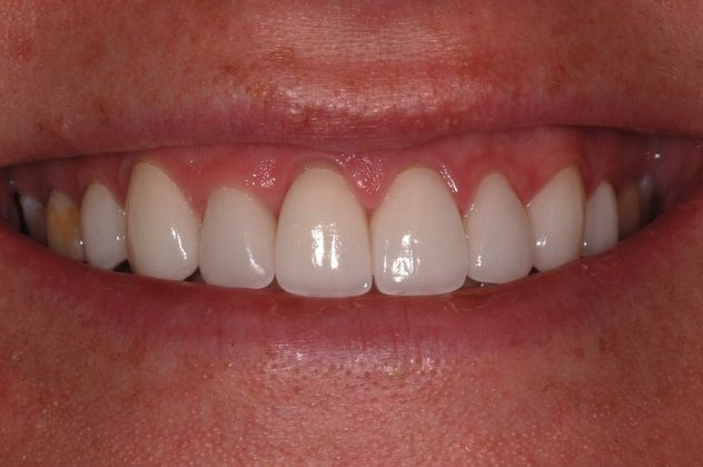 Austin patient after veneers