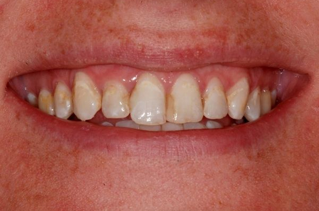 Austin patient before veneers