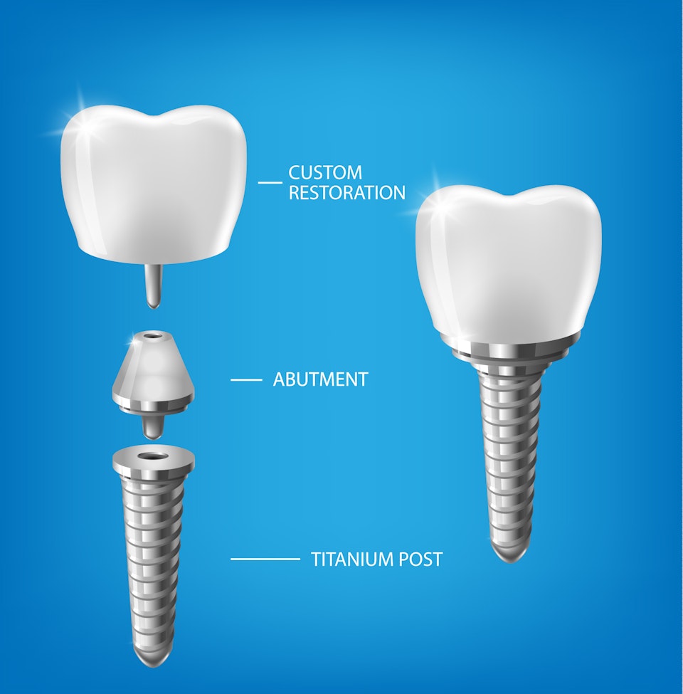 diagram of the parts of a dental implant