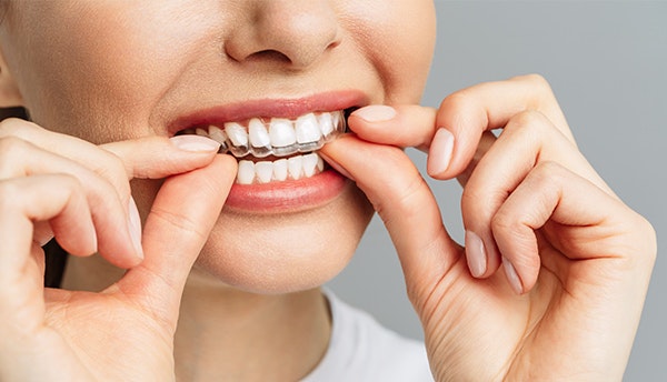 Woman putting a clear aligner over her teeth