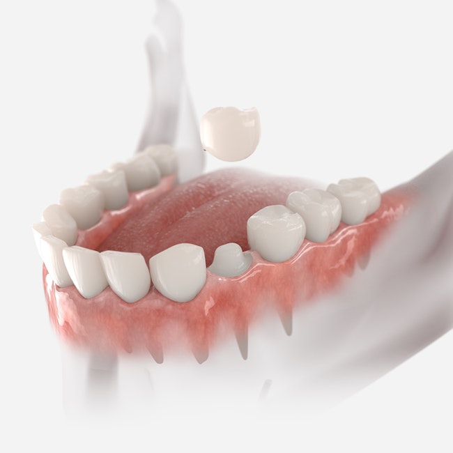 Your tooth will be reshaped to make room for the custom crown to be placed over and then secured with dental cement.