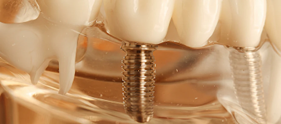 Dental Implants