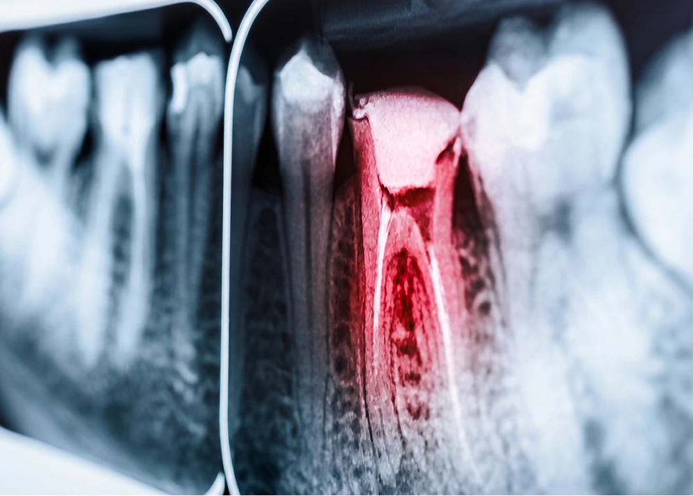X-ray of a root canal
