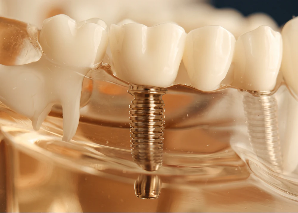 Dental Implants