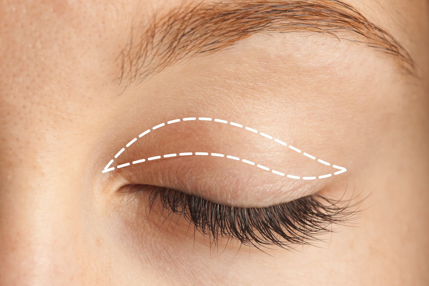 Photo of a woman with blepharoplasty lines drawn